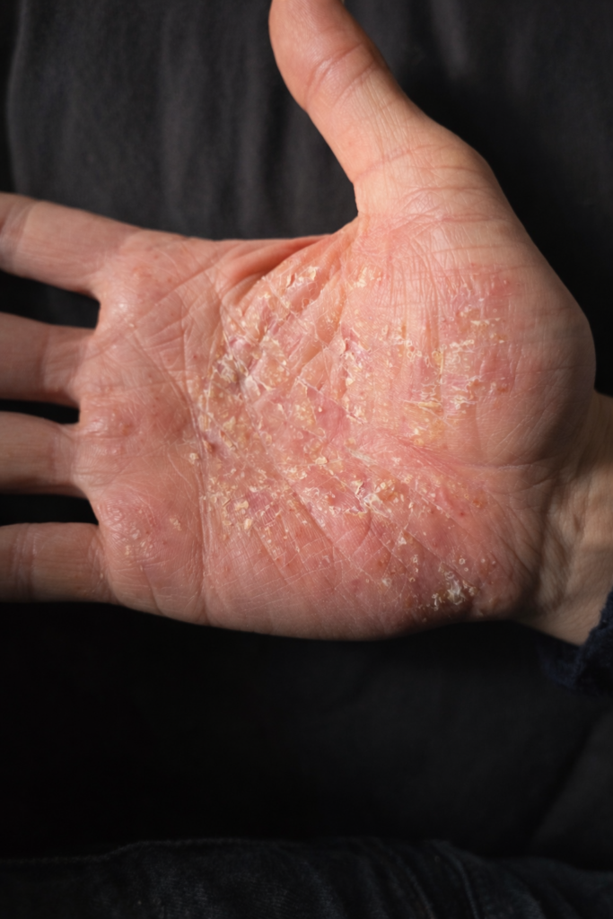 burn-out reconstruction corps symptôme fatigue stress main 